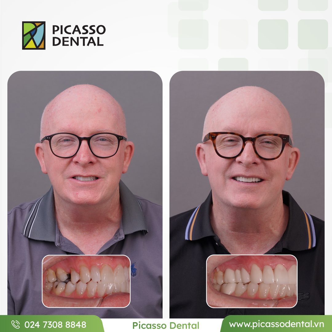 Before and after photo of single dental implant treatment at Picasso Dental Clinic