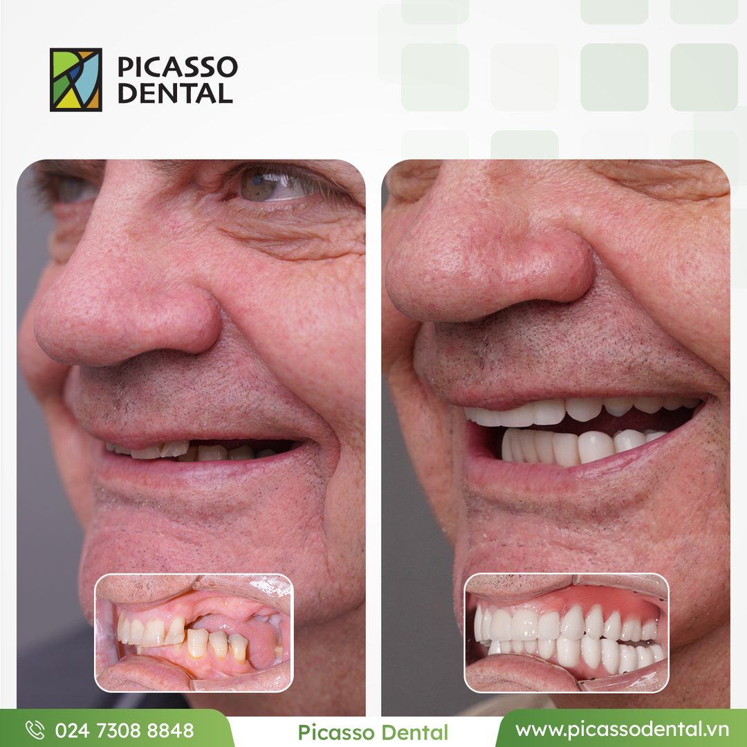 Before and after photo of multiple dental implants at Picasso Dental Clinic