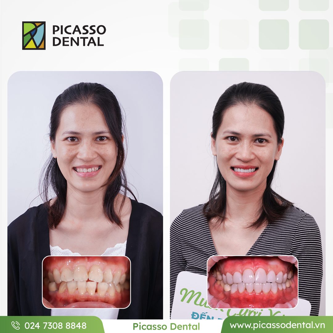 Before and after photo of porcelain veneers at Picasso Dental Clinic