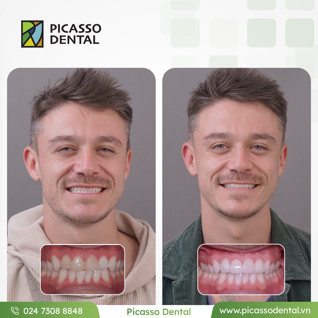 Before and after photo of veneers and crowns combination at Picasso Dental Clinic