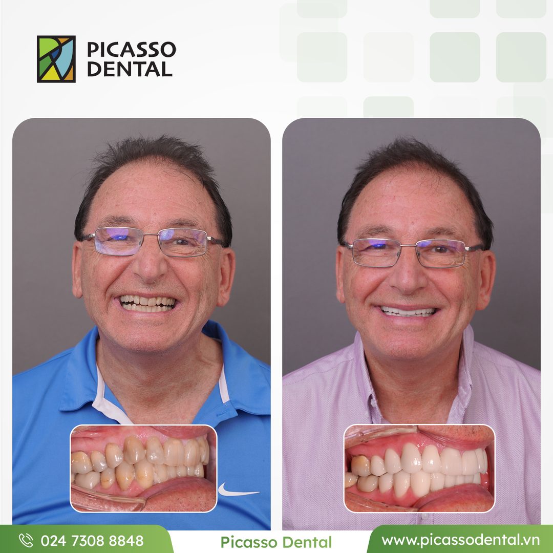 Before and after photo of full mouth rehabilitation with veneers, crowns and implants