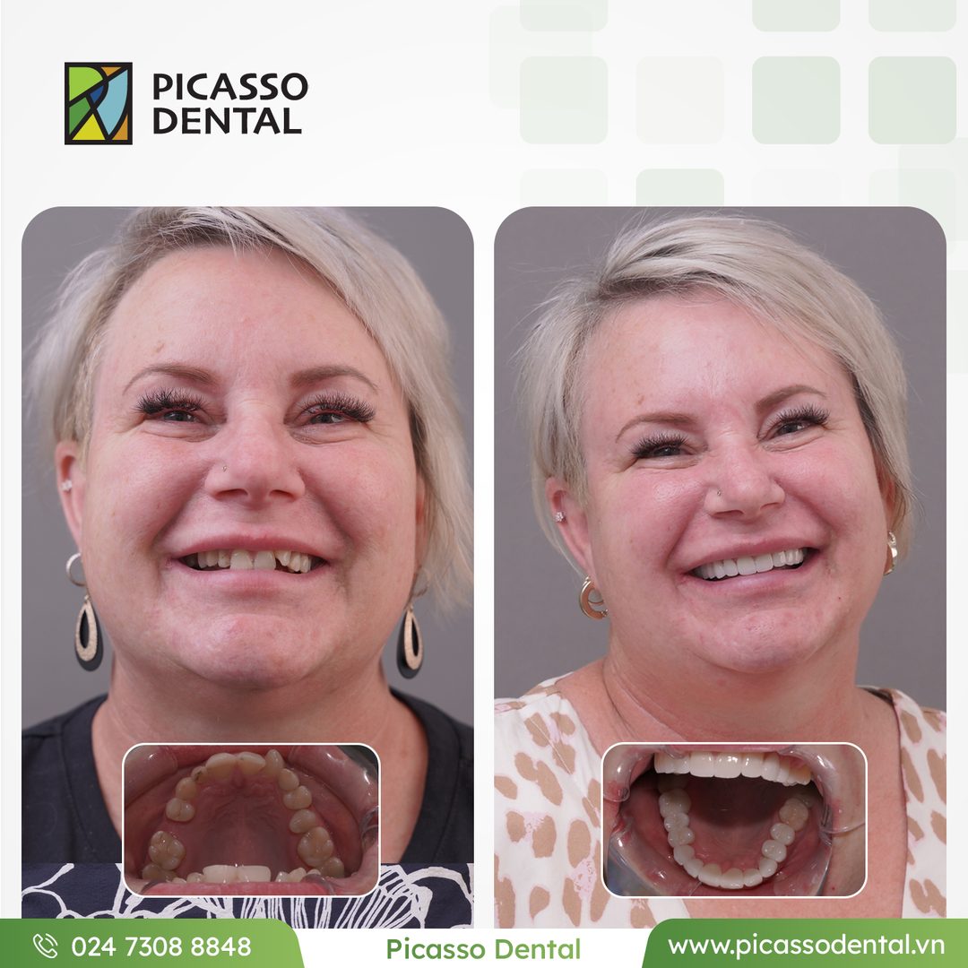 Виниры и коронка — передняя зона — кейс пациента Picasso Dental