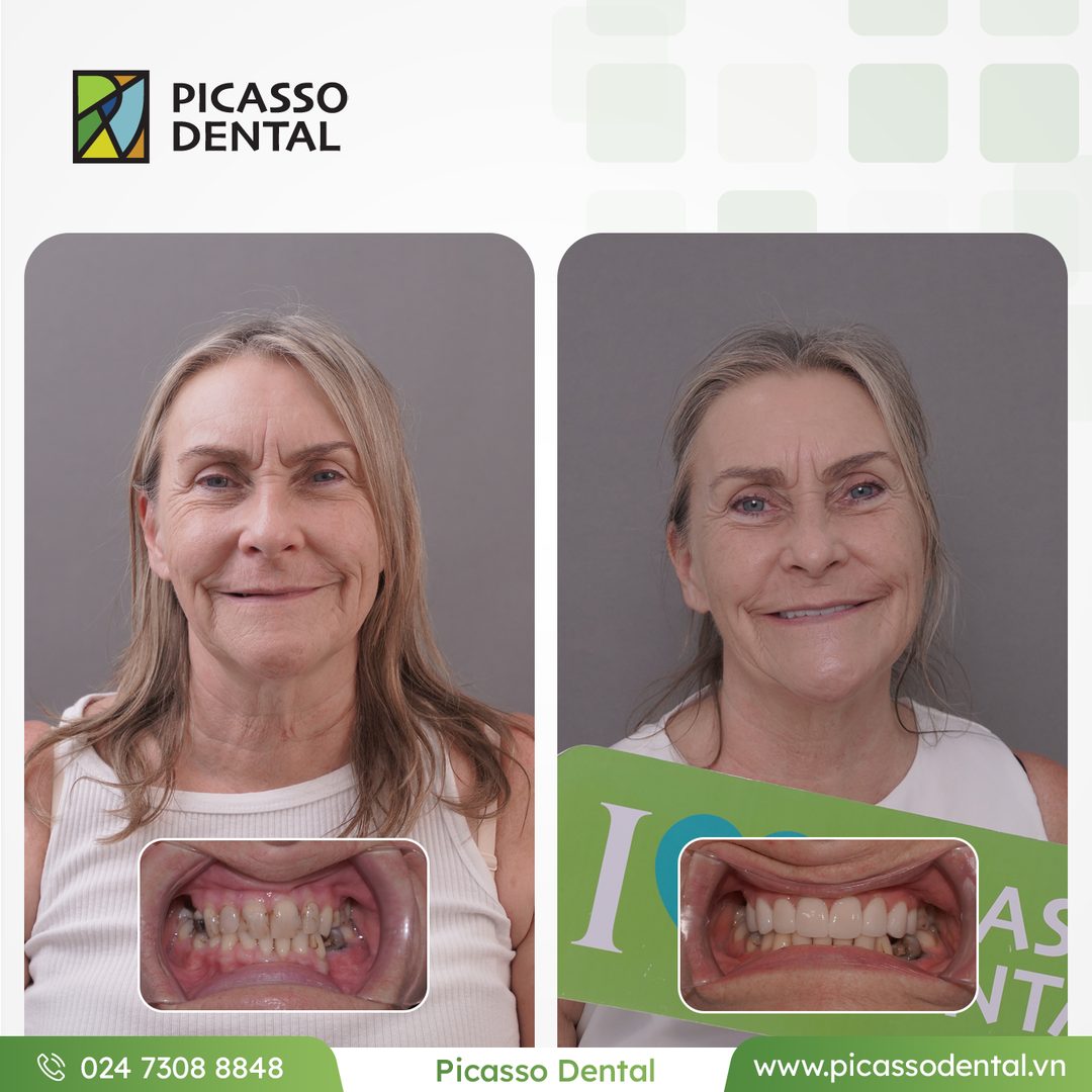 Виниры и коронки — полная улыбка — кейс пациента Picasso Dental