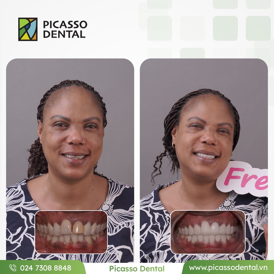 Виниры и коронки — кейс пациента Picasso Dental