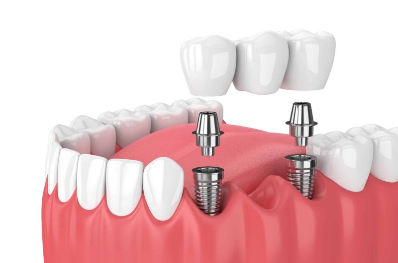 3 Types Of Dental Bridge