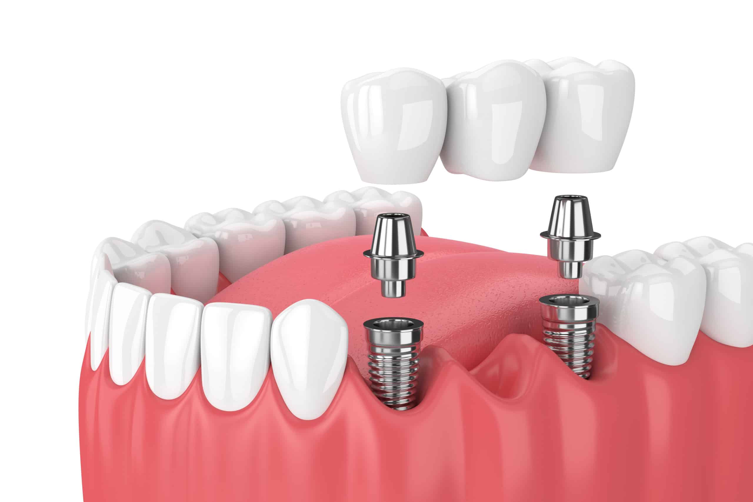 3 Types Of Dental Bridge