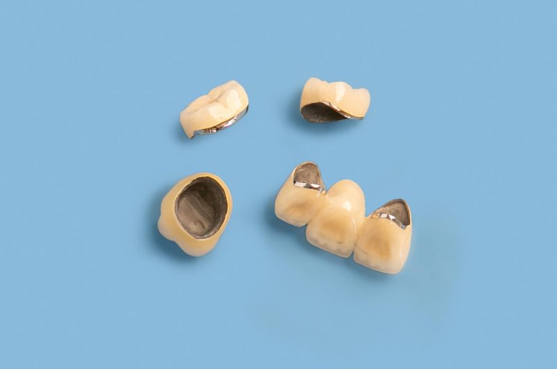 Comparison Of All-Porcelain Crown Vs. Porcelain Fused To Metal Crown