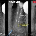 Broken File In Root Canal During Root Canal Treatment