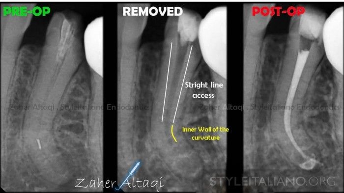 Broken File In Root Canal During Root Canal Treatment