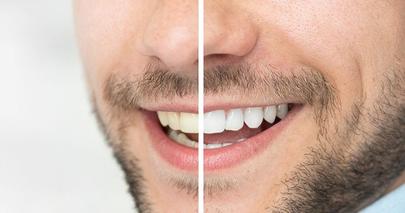 Teeth Whitening – An Easy, Effective Way To Improve Your Smile