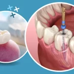 Crown After A Root Canal Treatment