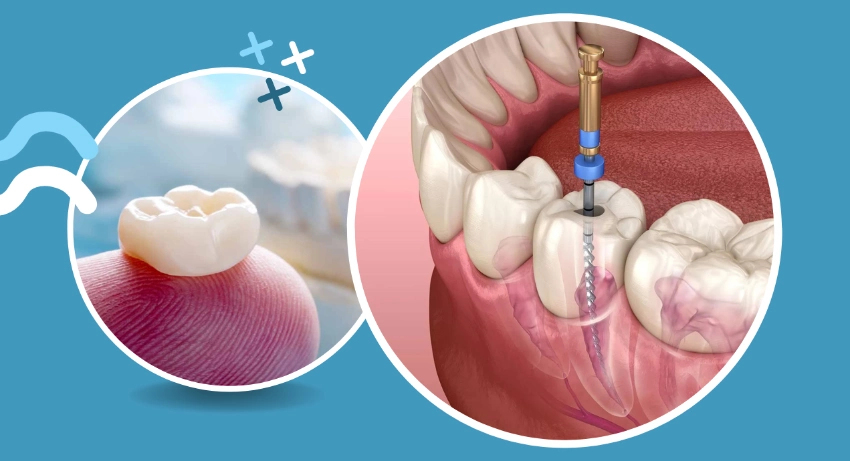 Do You Always Need A Crown After A Root Canal Treatment?