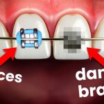 Damon Braces Vs. Traditional Metal Braces