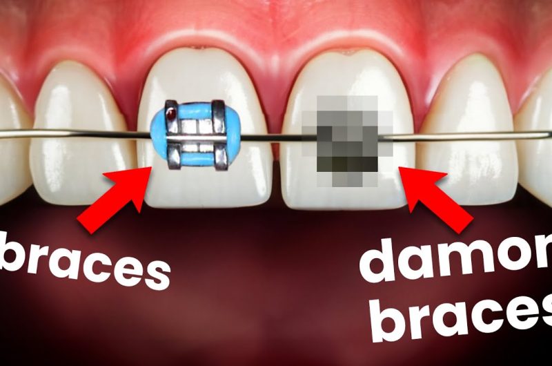 Damon Braces Vs. Traditional Metal Braces: Which One Is Better?