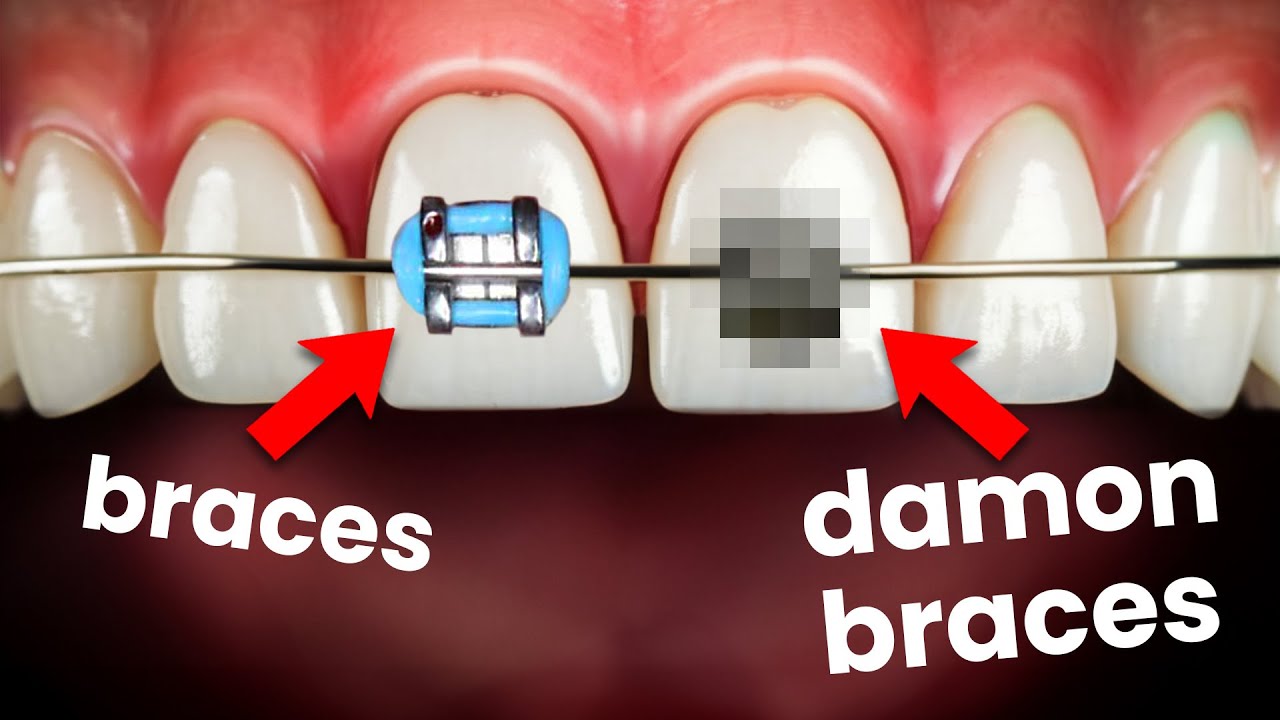 Damon Braces Vs. Traditional Metal Braces: Which One Is Better?