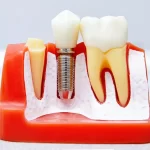 Dental Implant Success Rate