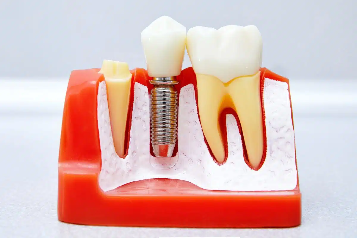 Dental Implant Success Rate