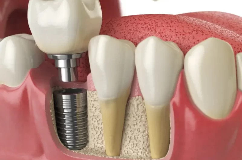 Dental Implants – A Tooth-Replacement Method That Rarely Fails