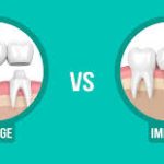 Dental Implants Vs. Bridgework