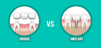 Dental Implants Vs. Bridgework