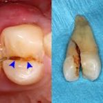 Fractured And Broken Teeth