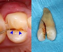 Fractured And Broken Teeth