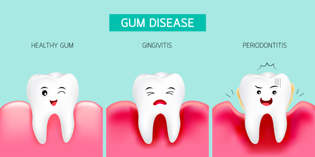 Gum Disease - Serenity International Dental Clinic Vietnam