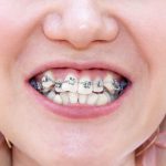 How Braces Straighten Crooked Teeth