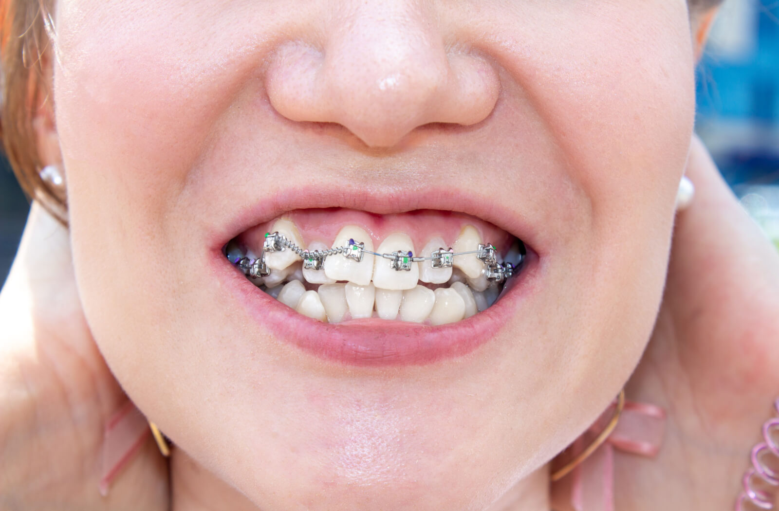 How Braces Straighten Crooked Teeth