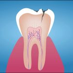 How To Avoid Dental Decay