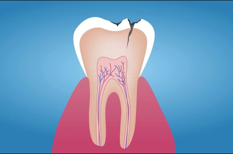 How To Avoid Dental Decay