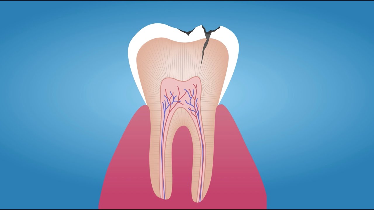 How To Avoid Dental Decay