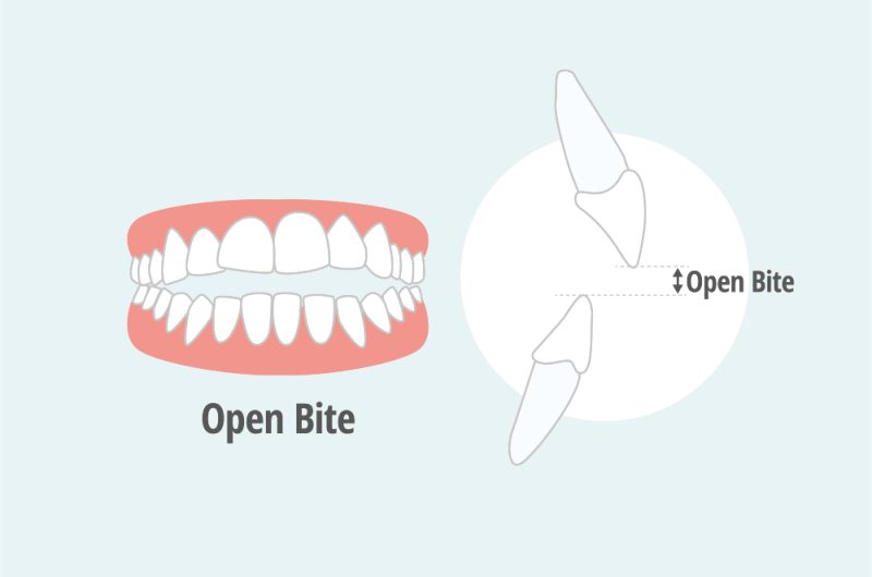 Open Bite: Symptoms, Causes, And Treatment Options