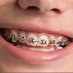 Orthodontic Treatment Timeline