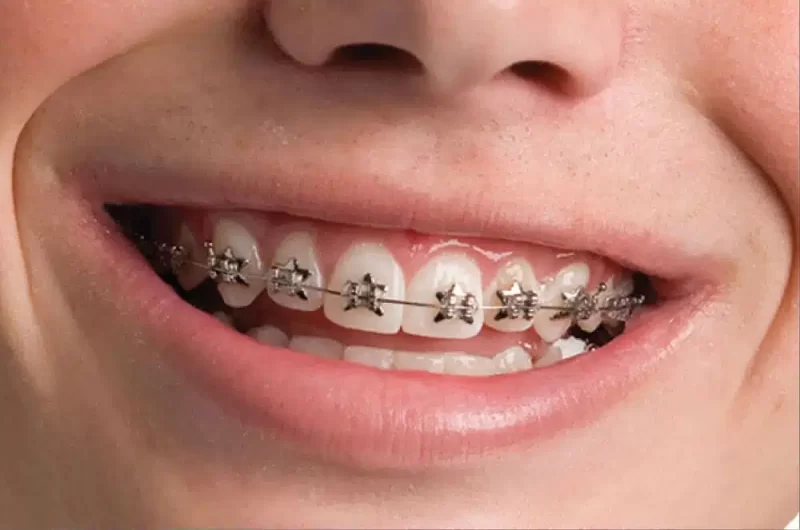 Orthodontic Treatment Timeline