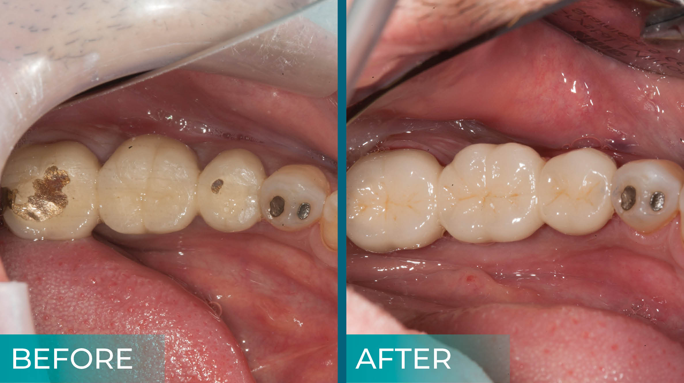 Comparision between Porcleain vs PFM crown: Which is better?