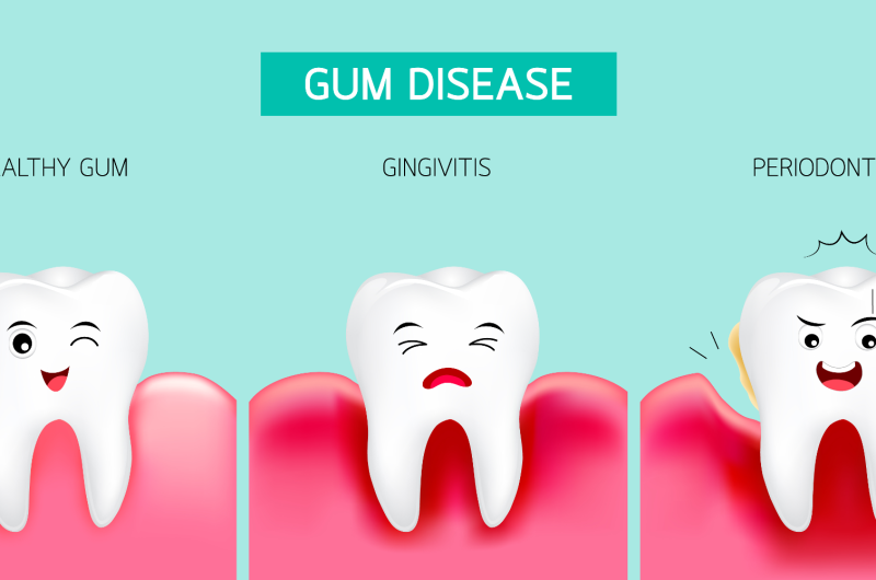 Prevention of Gum Diseases