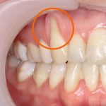 Receding Gums Symptoms And Causes