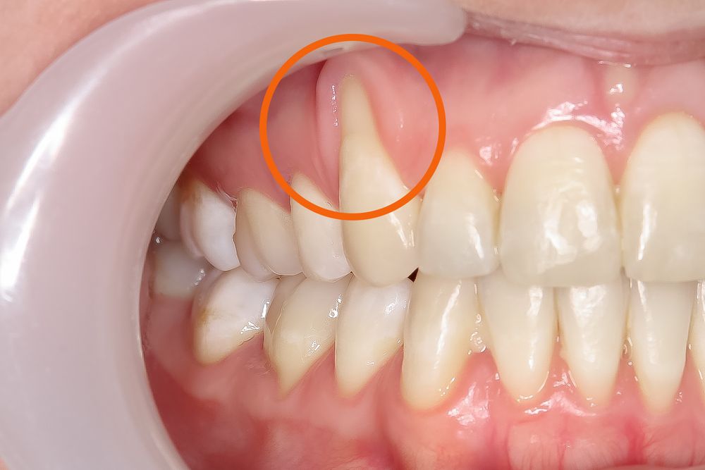 Receding Gums Symptoms And Causes