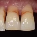 Receding Gums Treatment