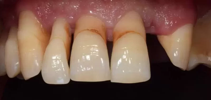 Receding Gums Treatment