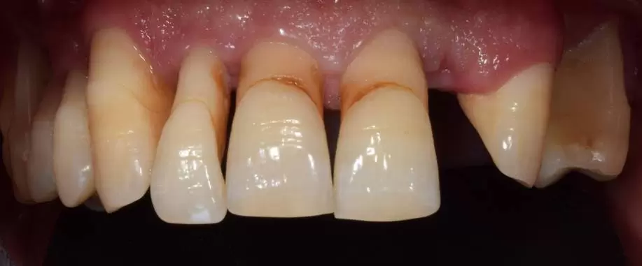 Receding Gums Treatment