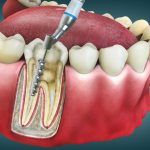 Root Canal Treatment