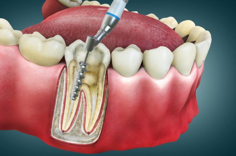 6 Steps Of Root Canal Treatment Procedure