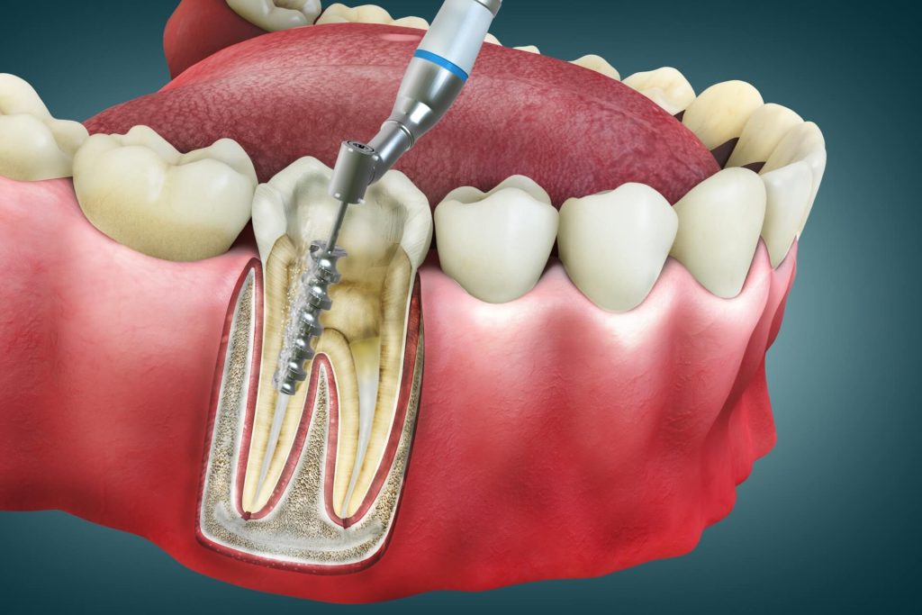 6 Steps Of Root Canal Treatment Procedure