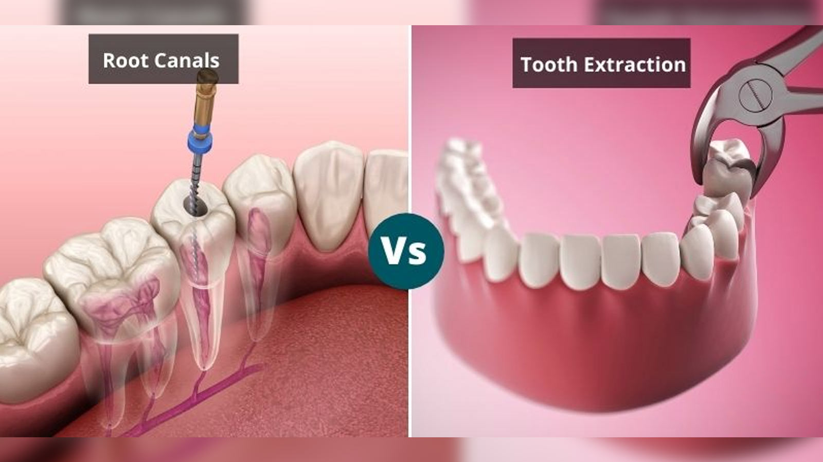 Root Canal Treatment vs. Tooth Extraction: Which Option Is Right for You?