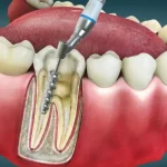 Side Effects Of Root Canal Treatment