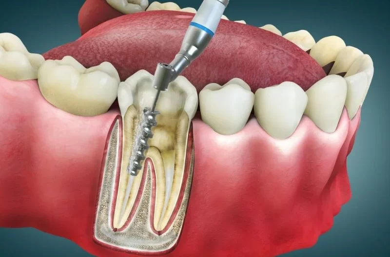 What Are The Side Effects Of Root Canal Treatment?