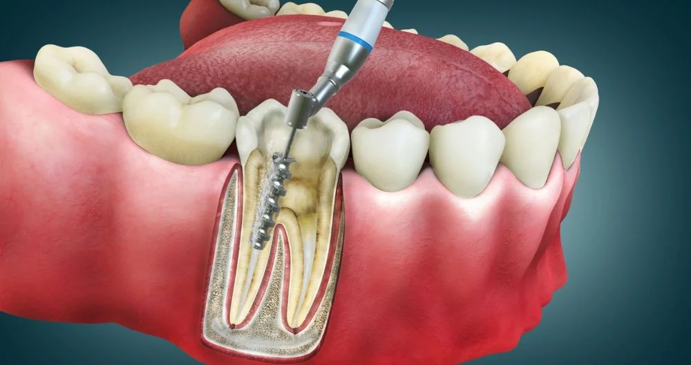 What Are The Side Effects Of Root Canal Treatment?