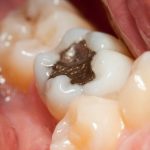 The Dangers Of Amalgam Fillings